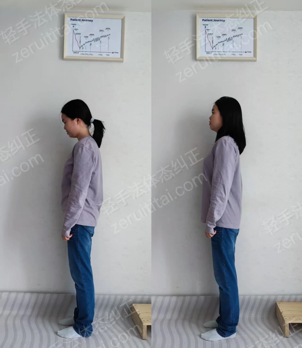 珠海小姐姐脊柱侧弯没气质