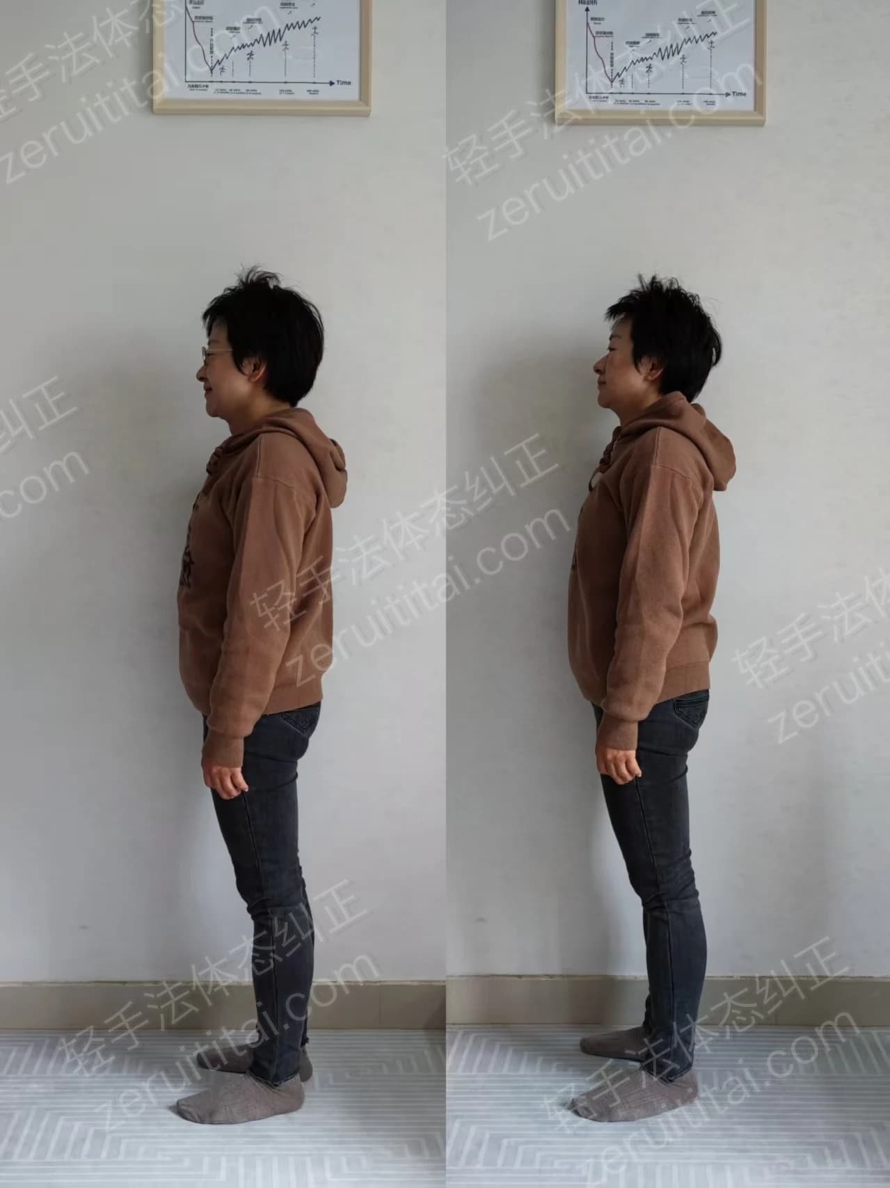 单次矫正案例对比 06