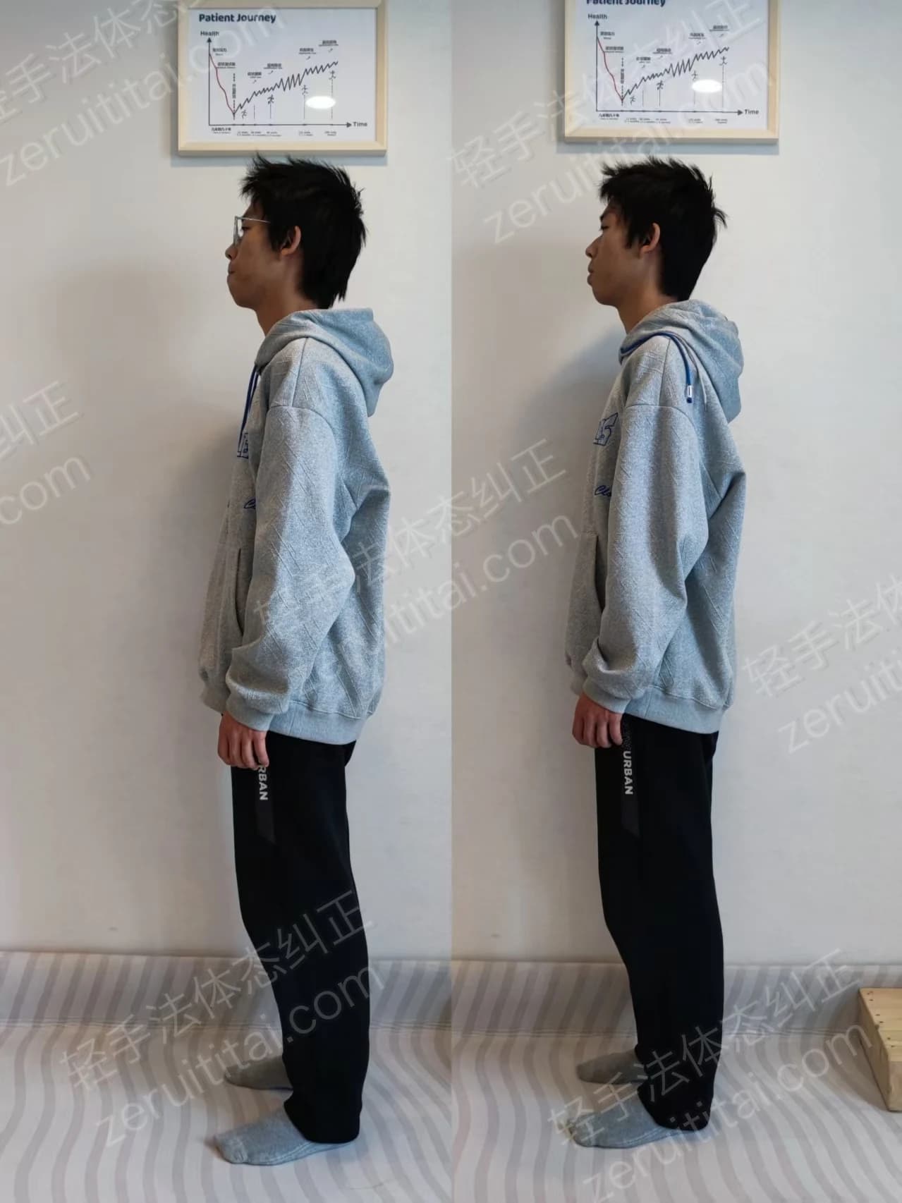 单次矫正案例对比 14