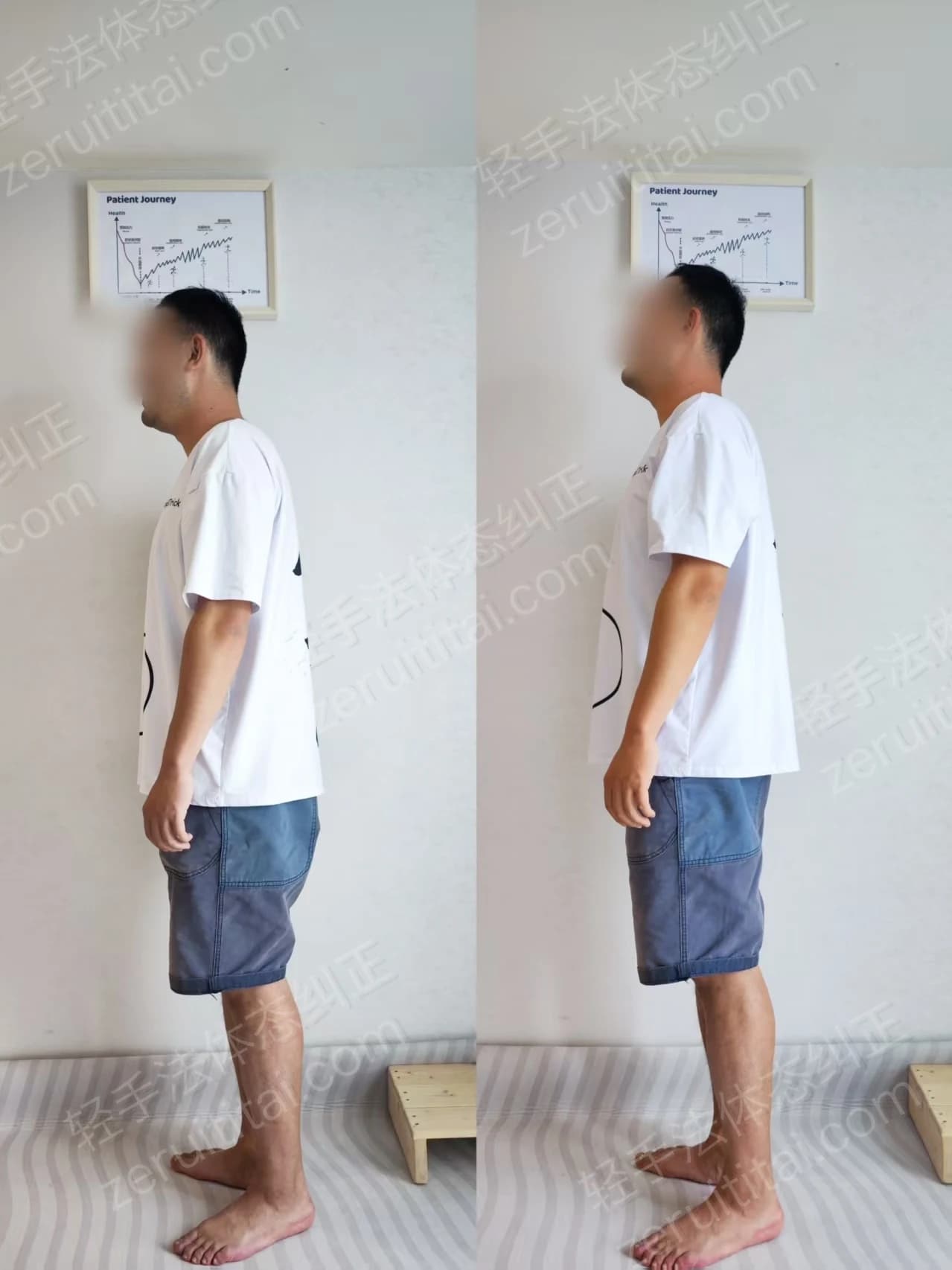 单次矫正案例对比 17