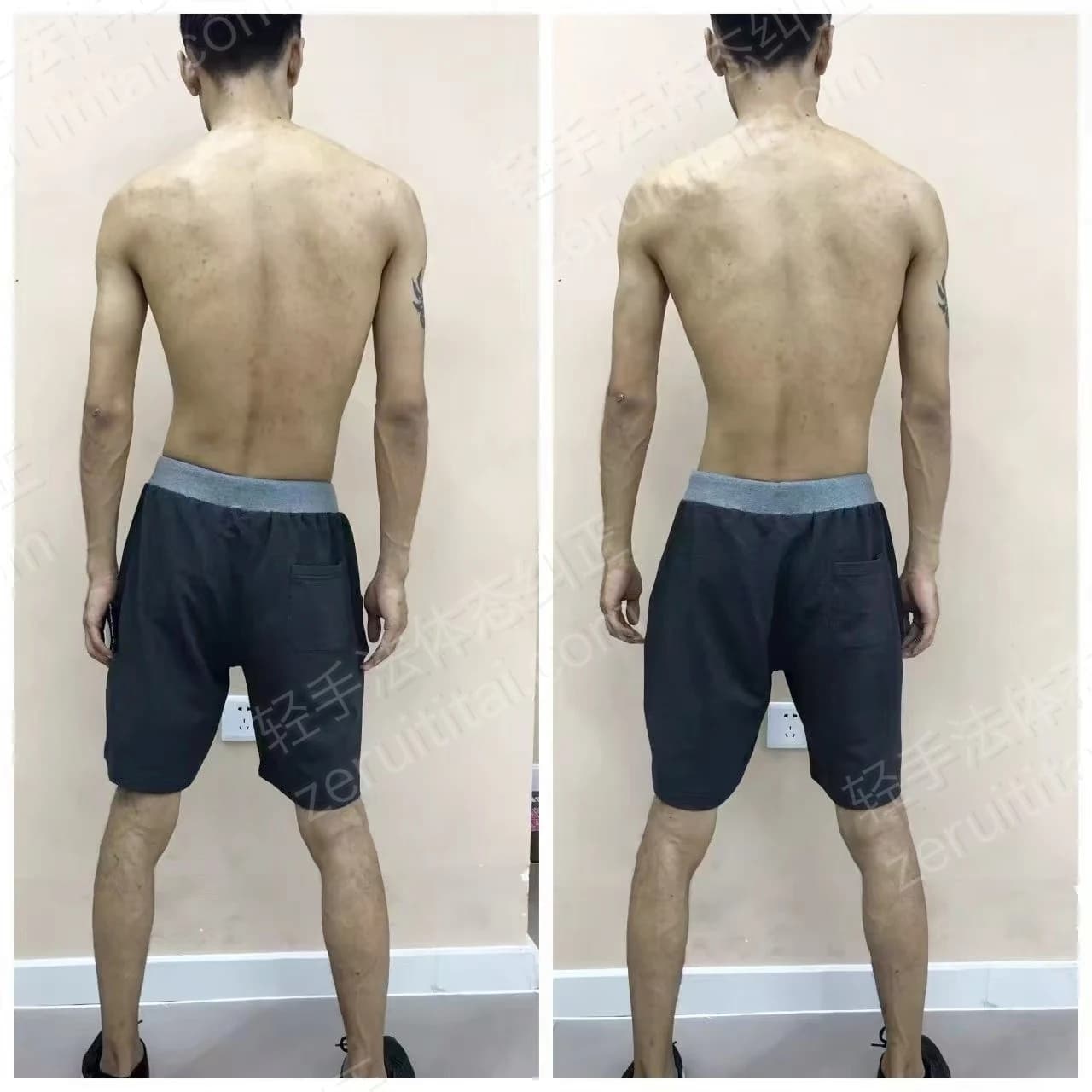 单次矫正案例对比 20