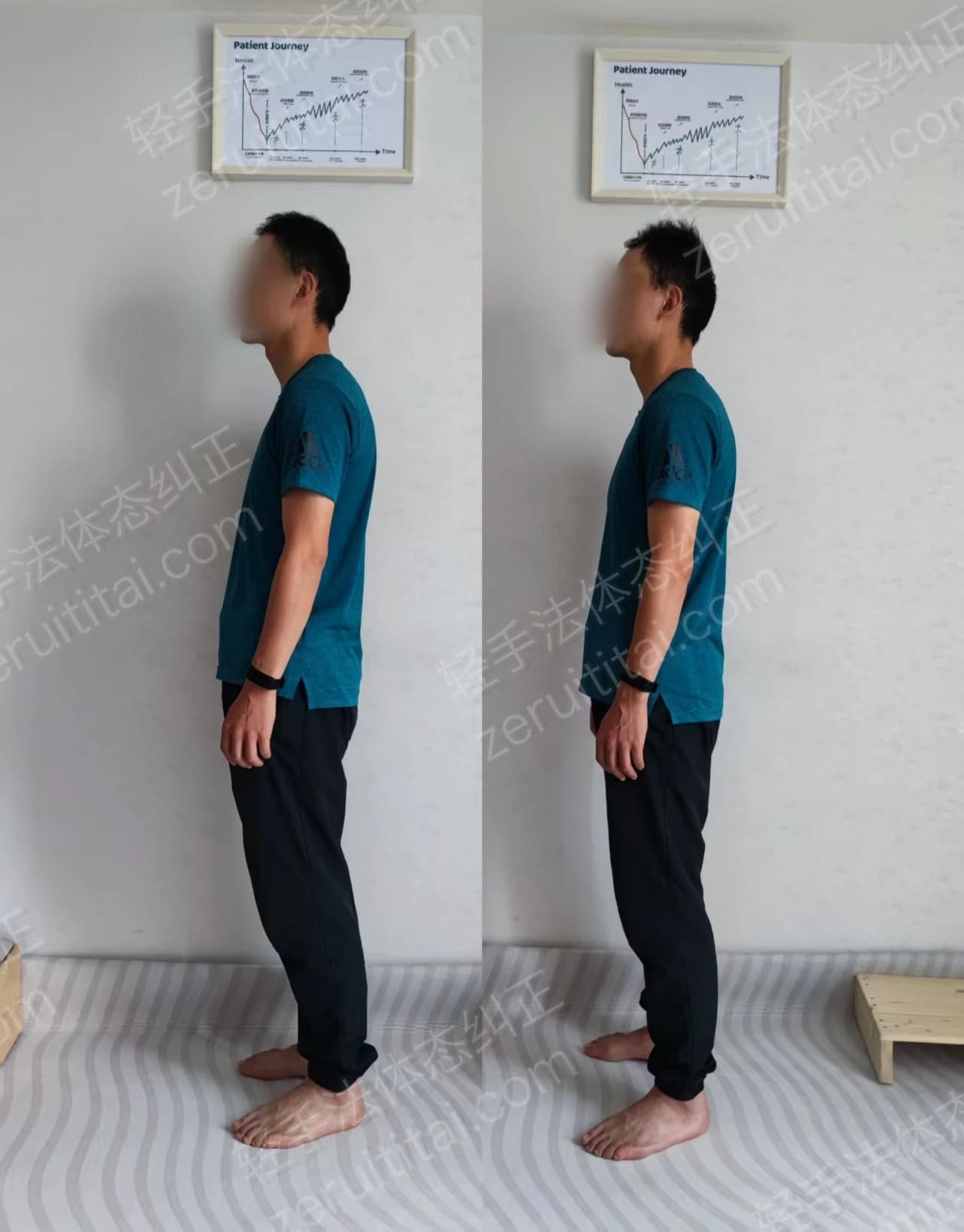 单次矫正案例对比 22