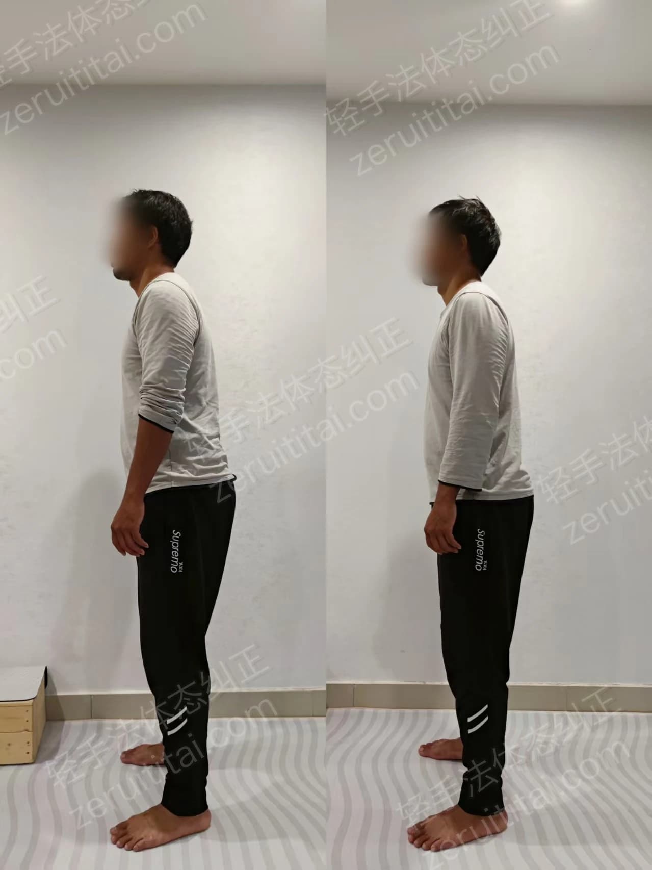 单次矫正案例对比 24