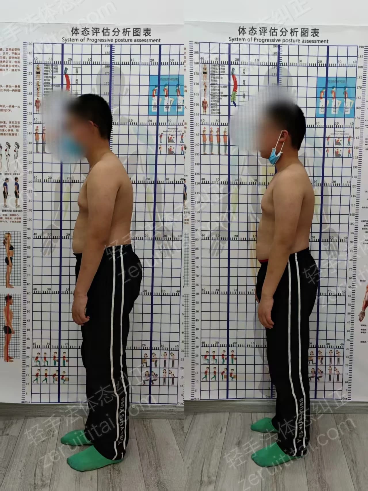 单次矫正案例对比 29