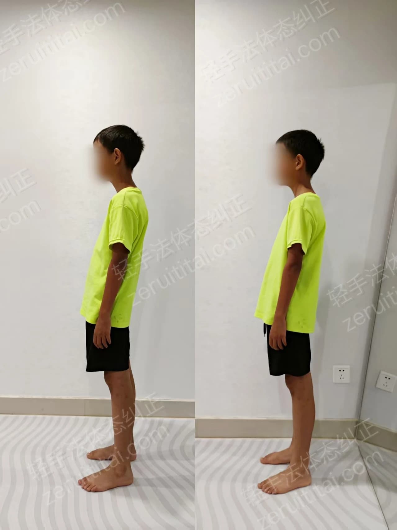 单次矫正案例对比 30