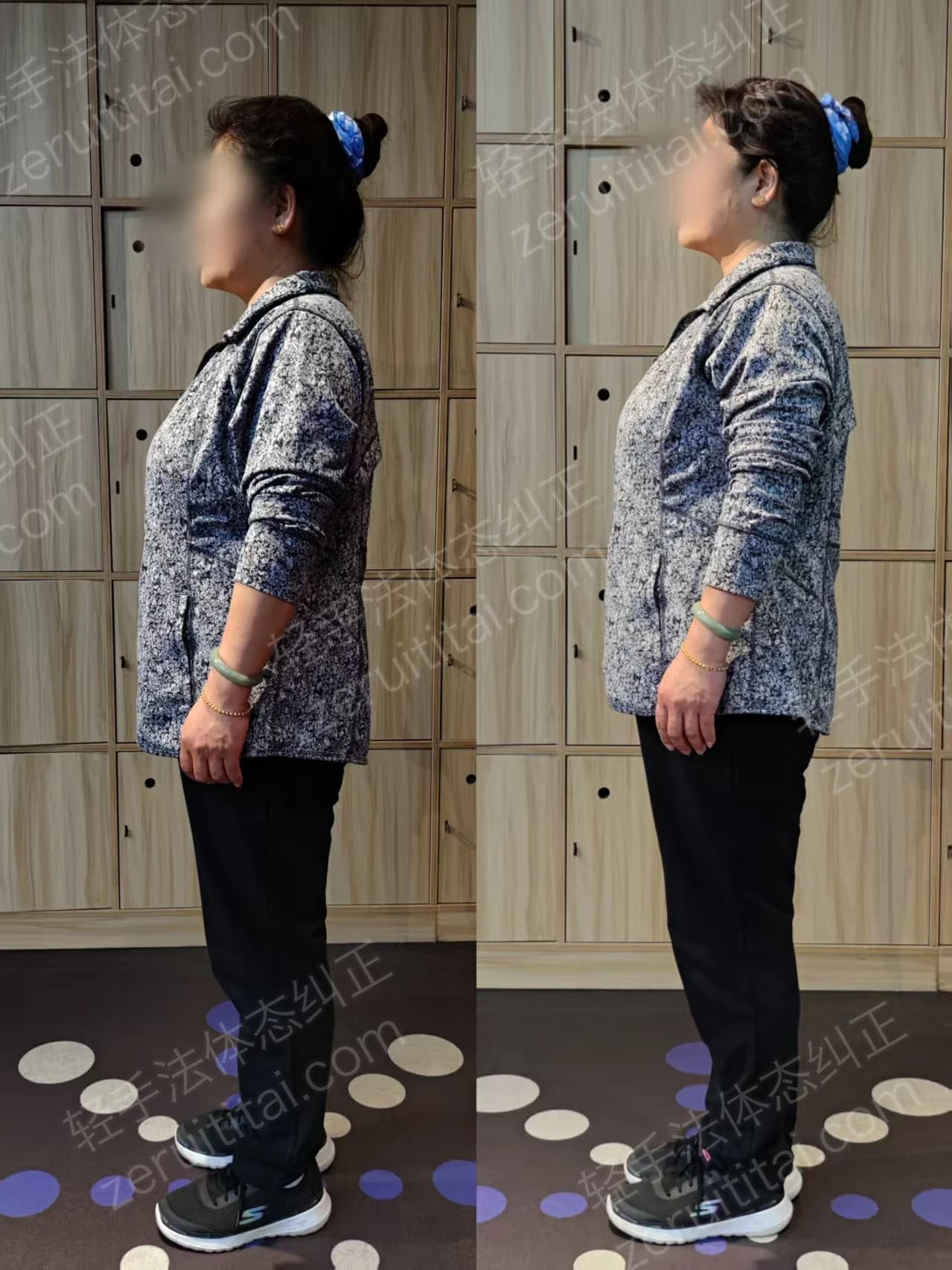 单次矫正案例对比 36