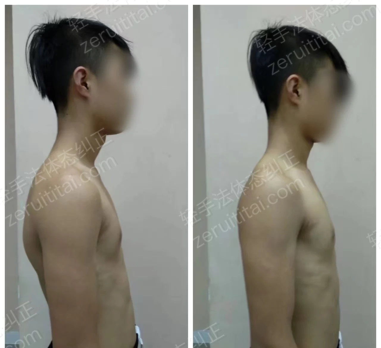 单次矫正案例对比 40