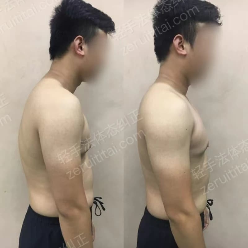 单次矫正案例对比 44