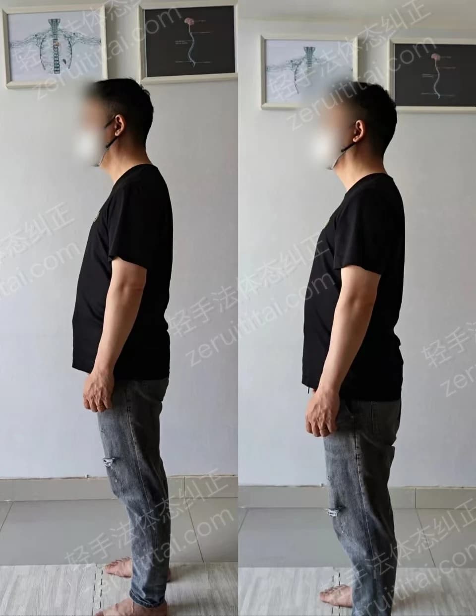 单次矫正案例对比 46