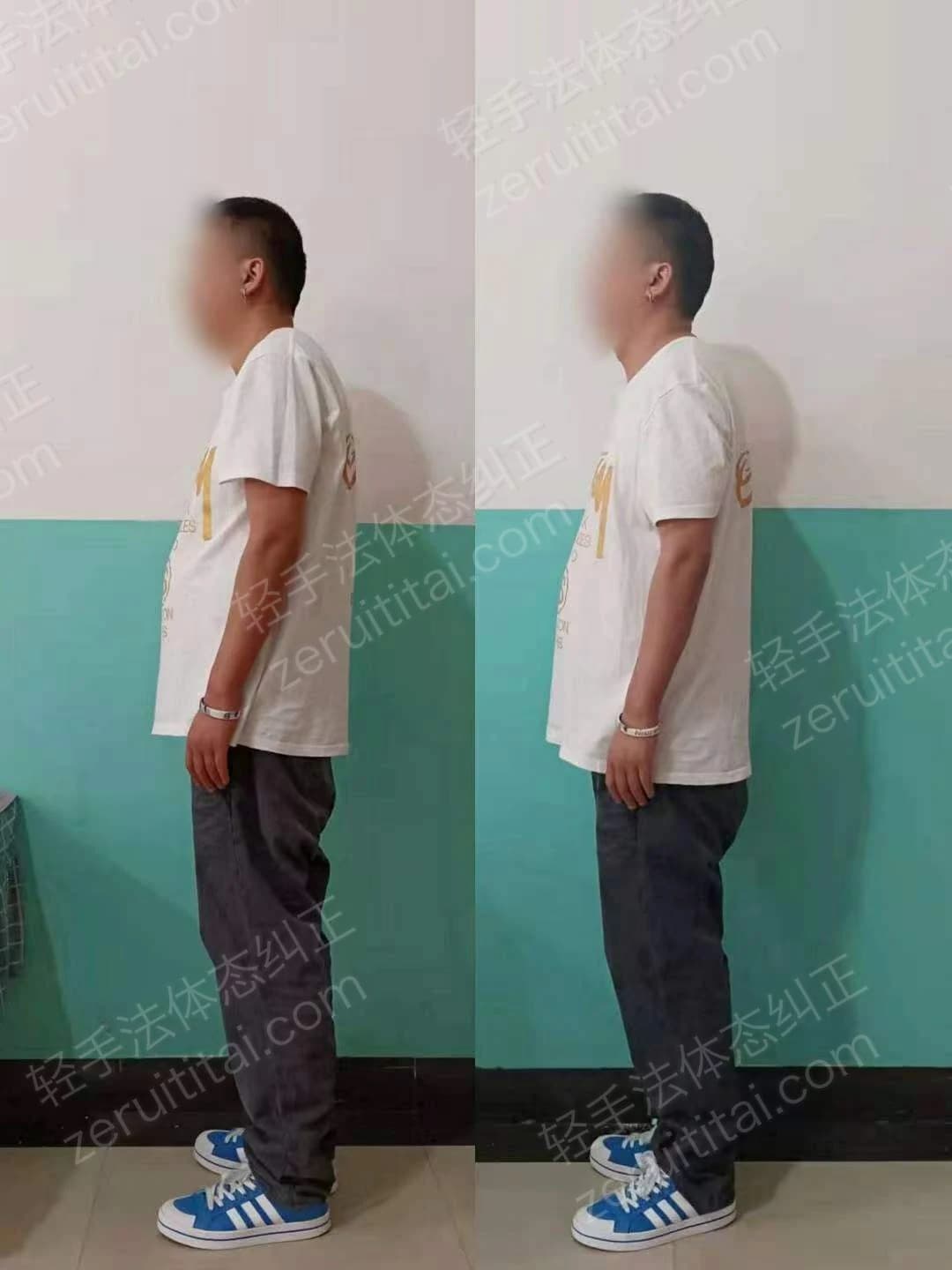 单次矫正案例对比 49