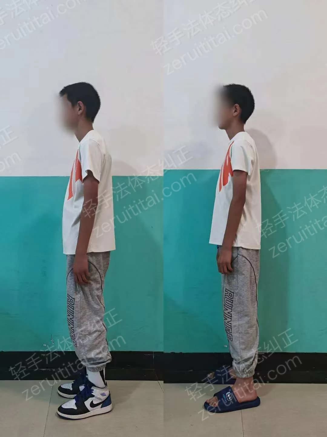 单次矫正案例对比 51