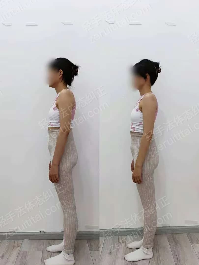 单次矫正案例对比 54