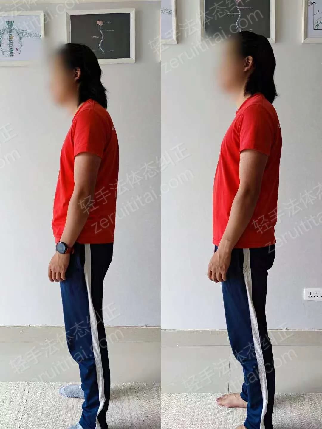 单次矫正案例对比 59