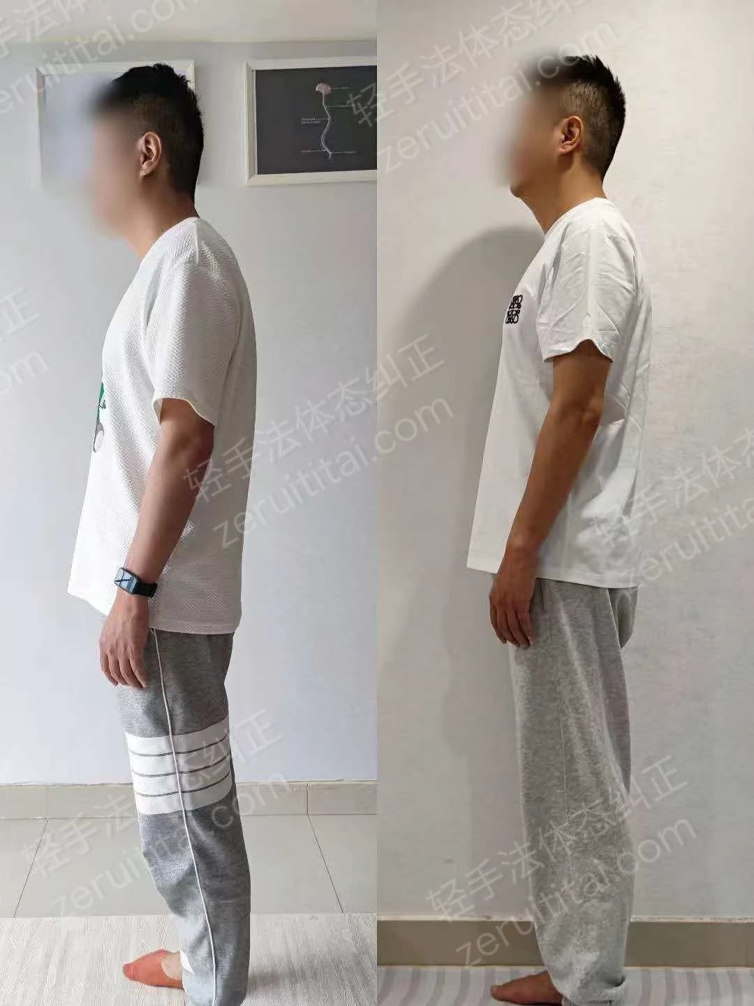 单次矫正案例对比 61