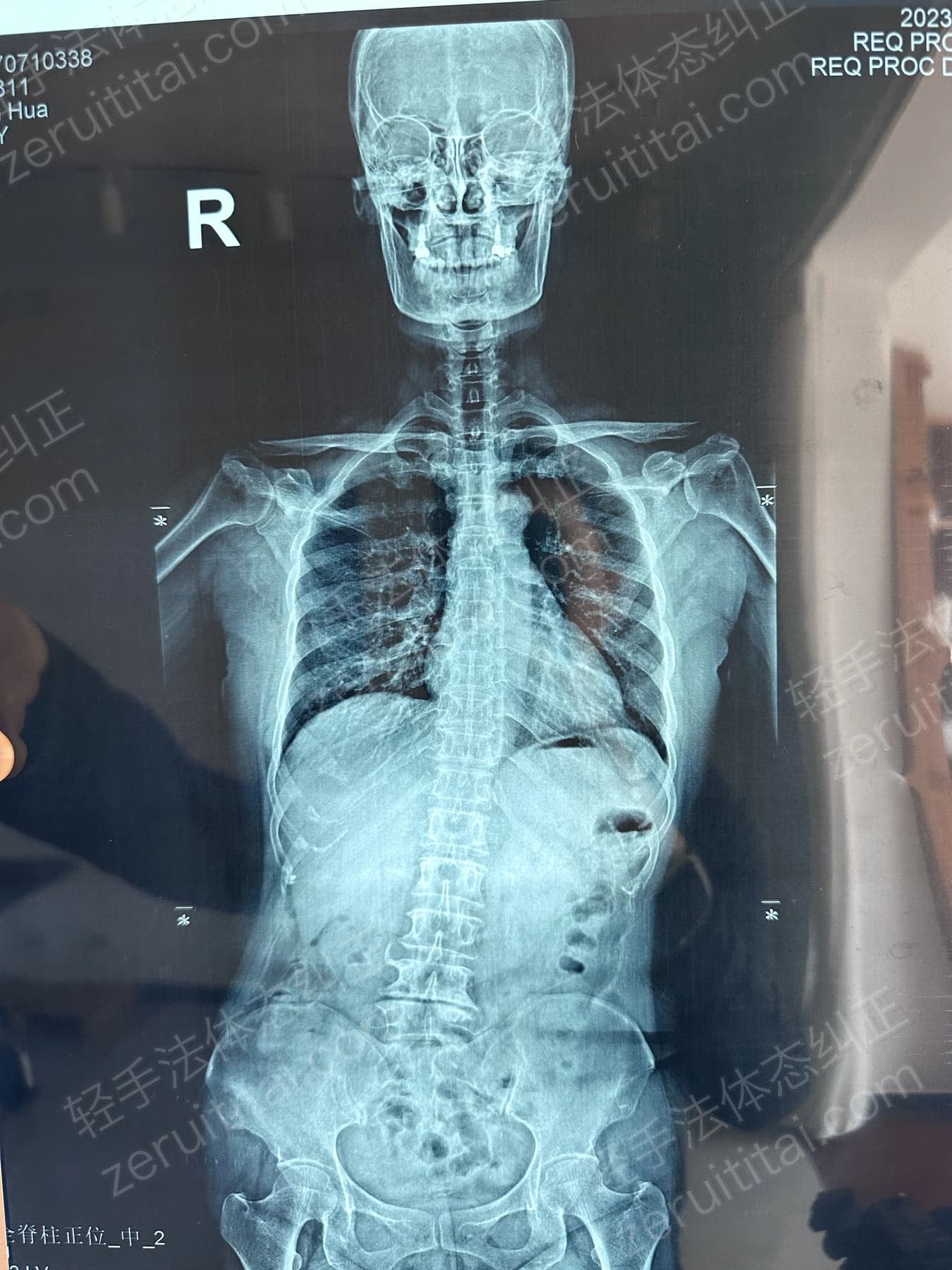 客户T阿姨 2023.07.07 正面 X光片