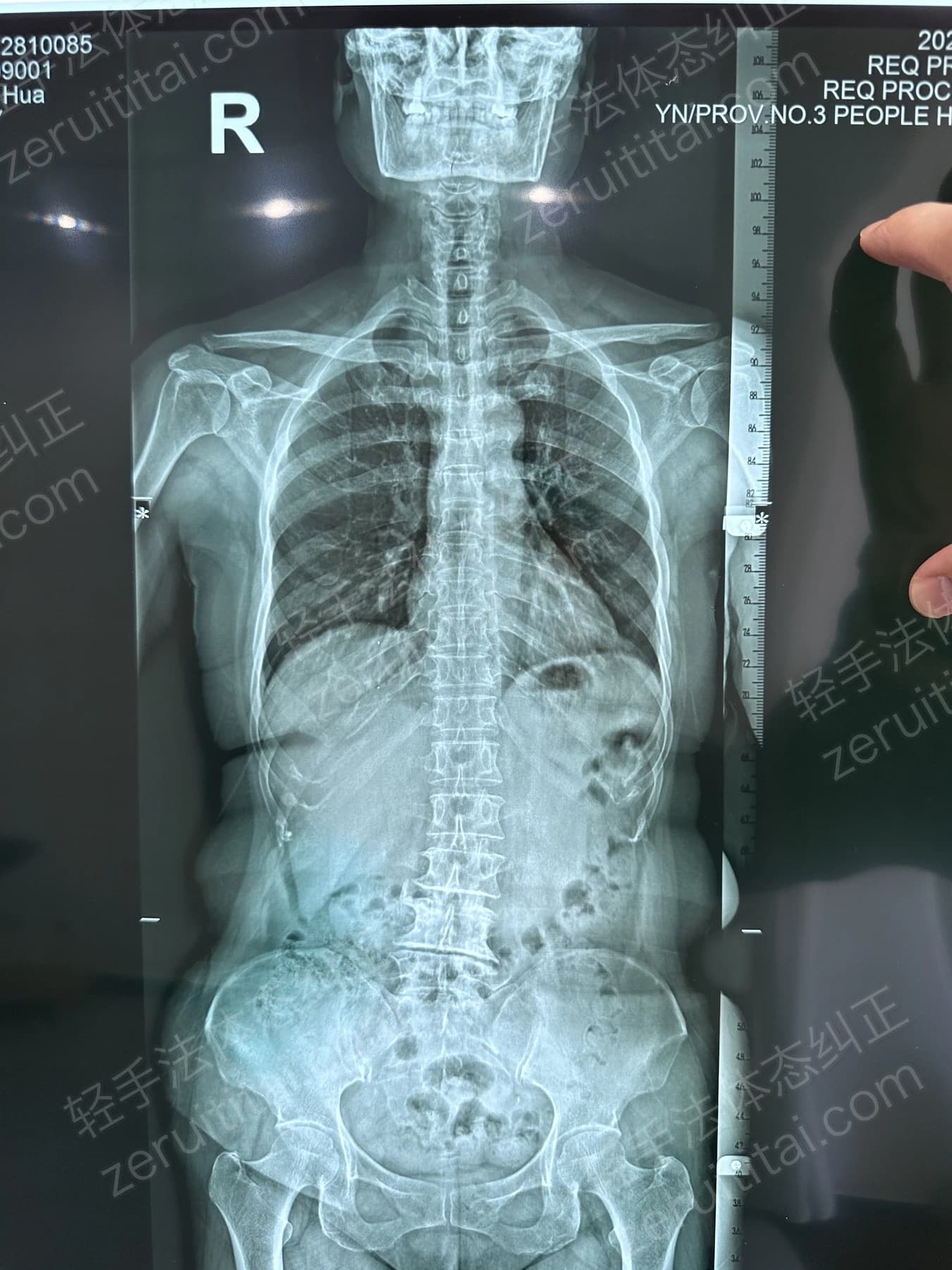 客户T阿姨 2025.12.28 正面 X光片