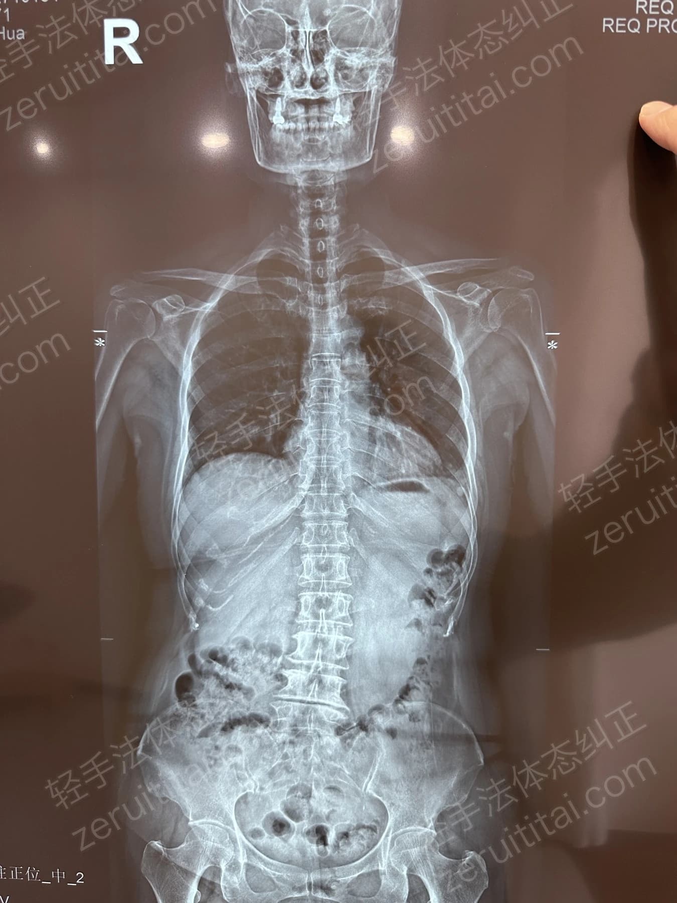 客户T阿姨 2025.04.27 正面 X光片