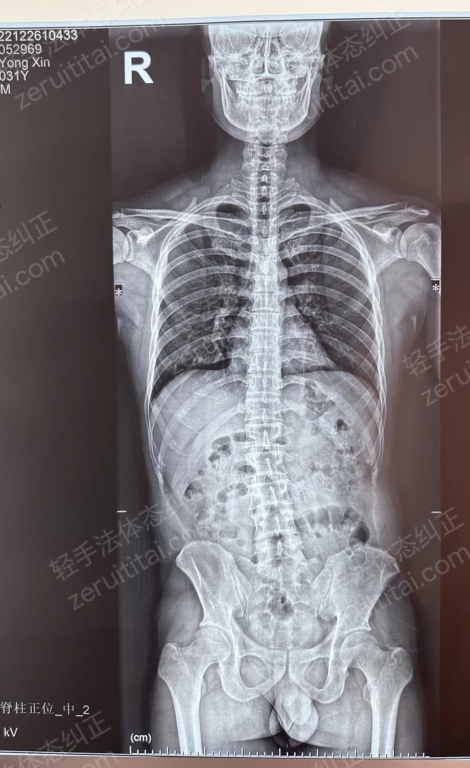 客户X老师 2022.12.26 正面 X光片