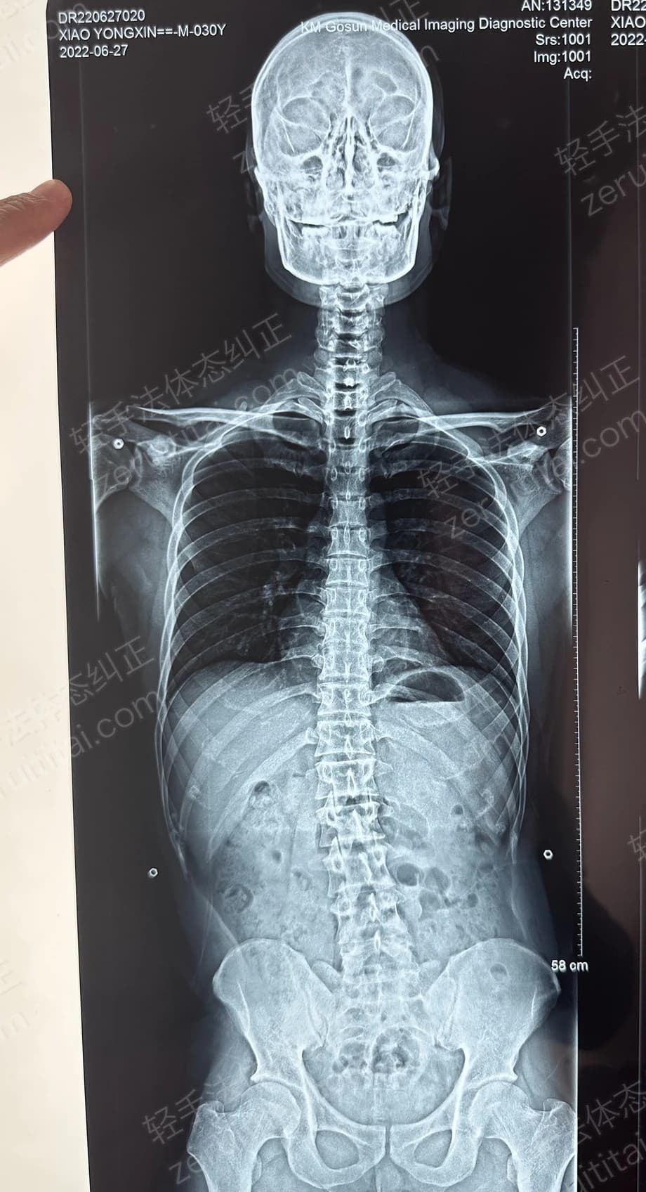 客户X老师 2022.06.27 正面 X光片