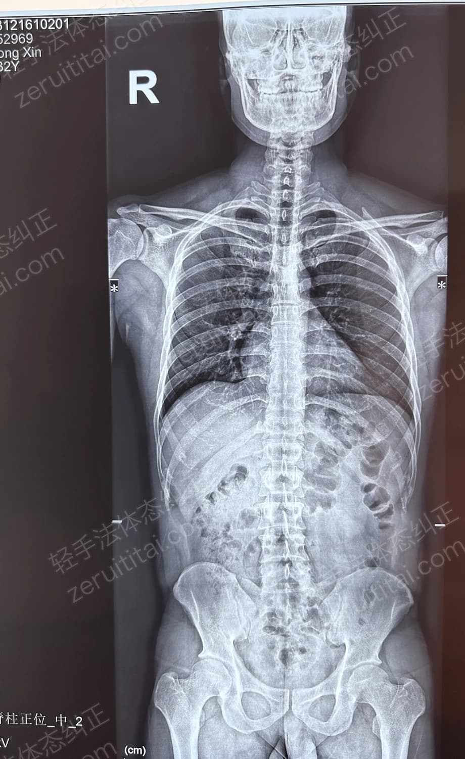 客户X老师 2023.12.16 正面 X光片