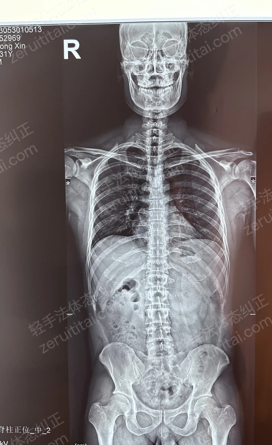 客户X老师 2023.05.30 正面 X光片