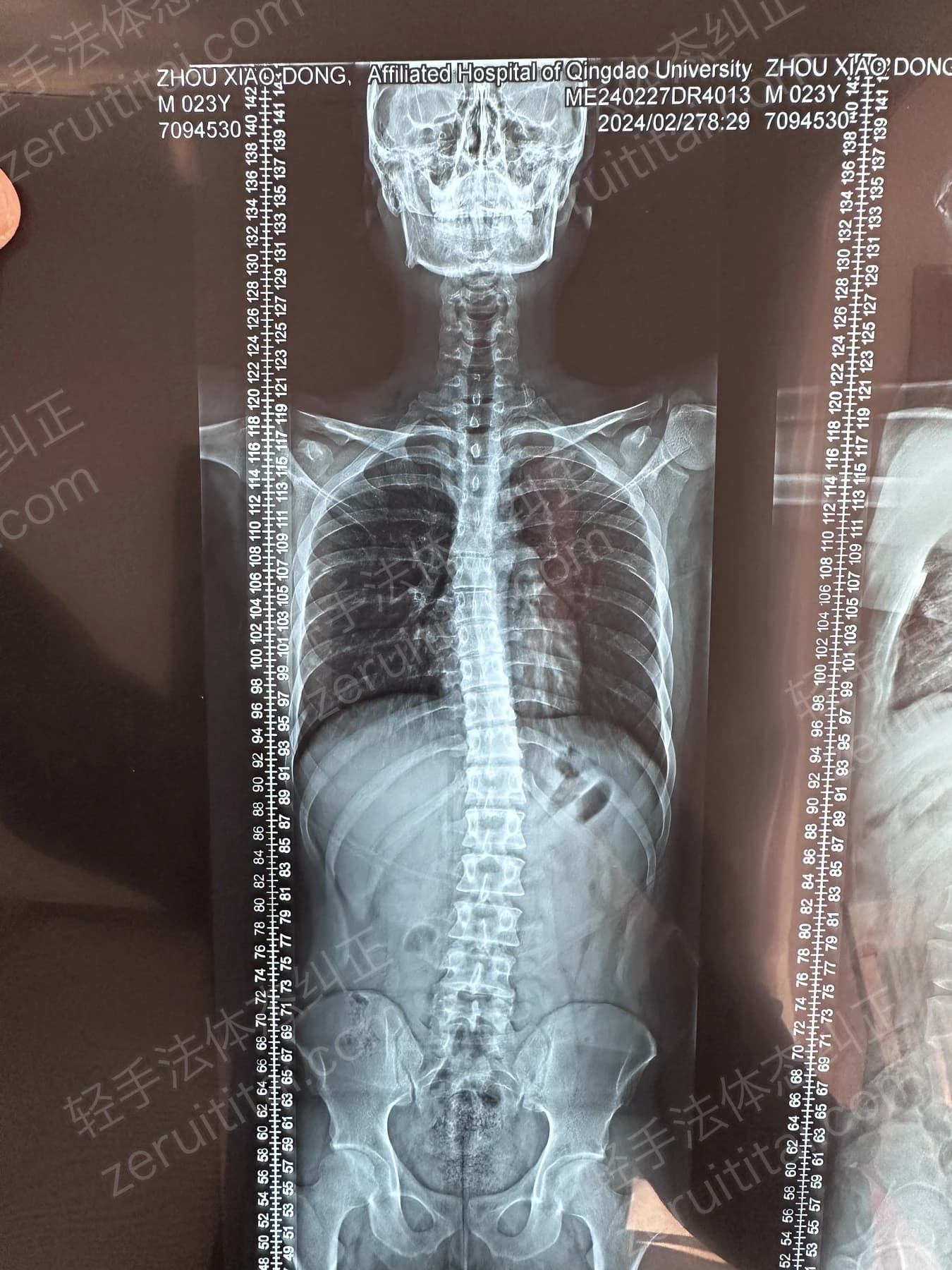 客户Z先生 2024.02.27 正面 X光片