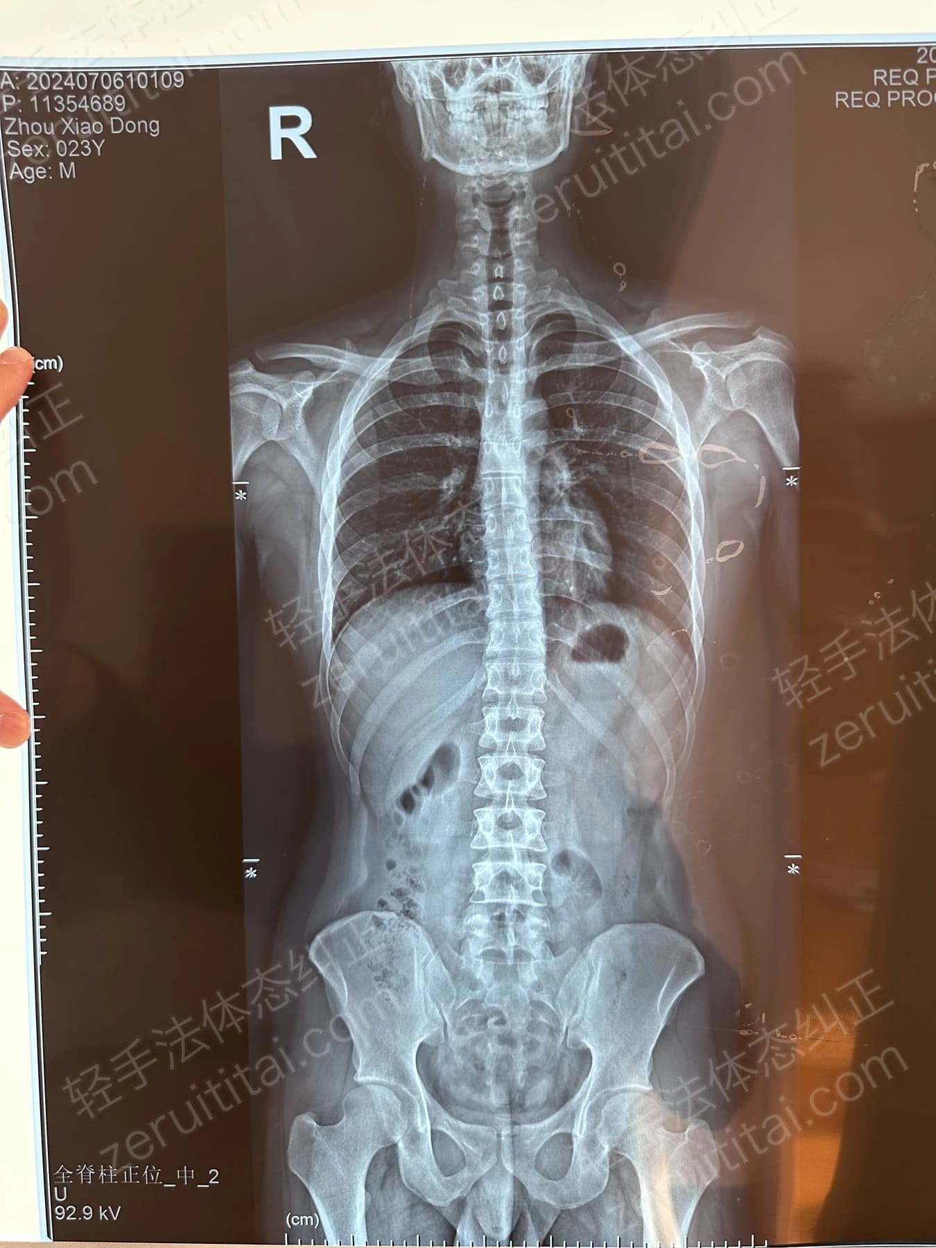 客户Z先生 2024.07.06 正面 X光片
