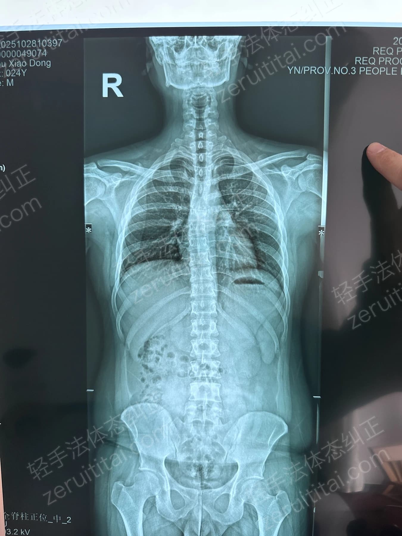 客户Z先生 2025.10.28 正面 X光片
