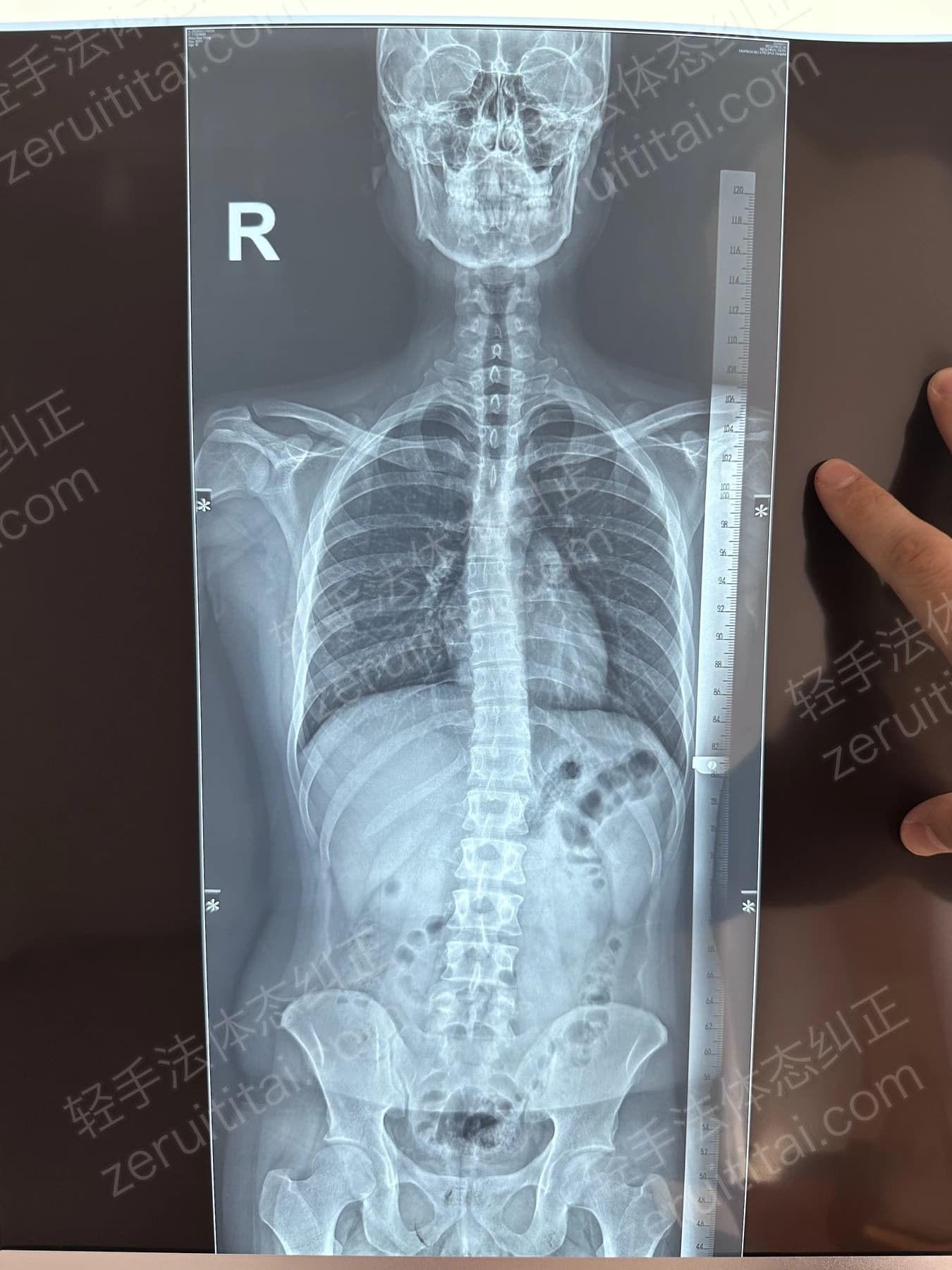 客户Z先生 2025.03.11 正面 X光片