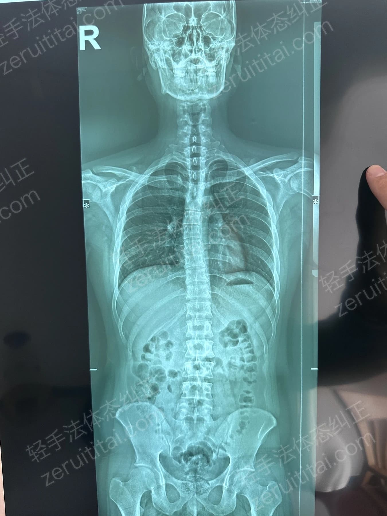 客户Z先生 2025.06.29 正面 X光片