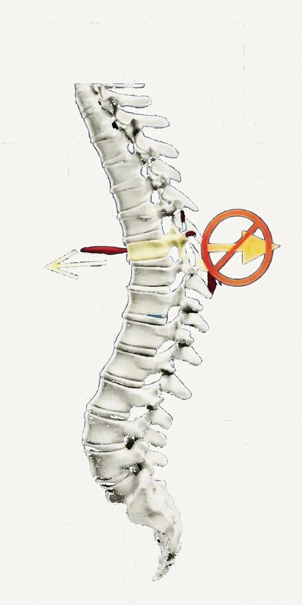 侧面脊柱示意图，表示椎骨一旦向前错位，后方没有肌肉能把它直接拉回原位