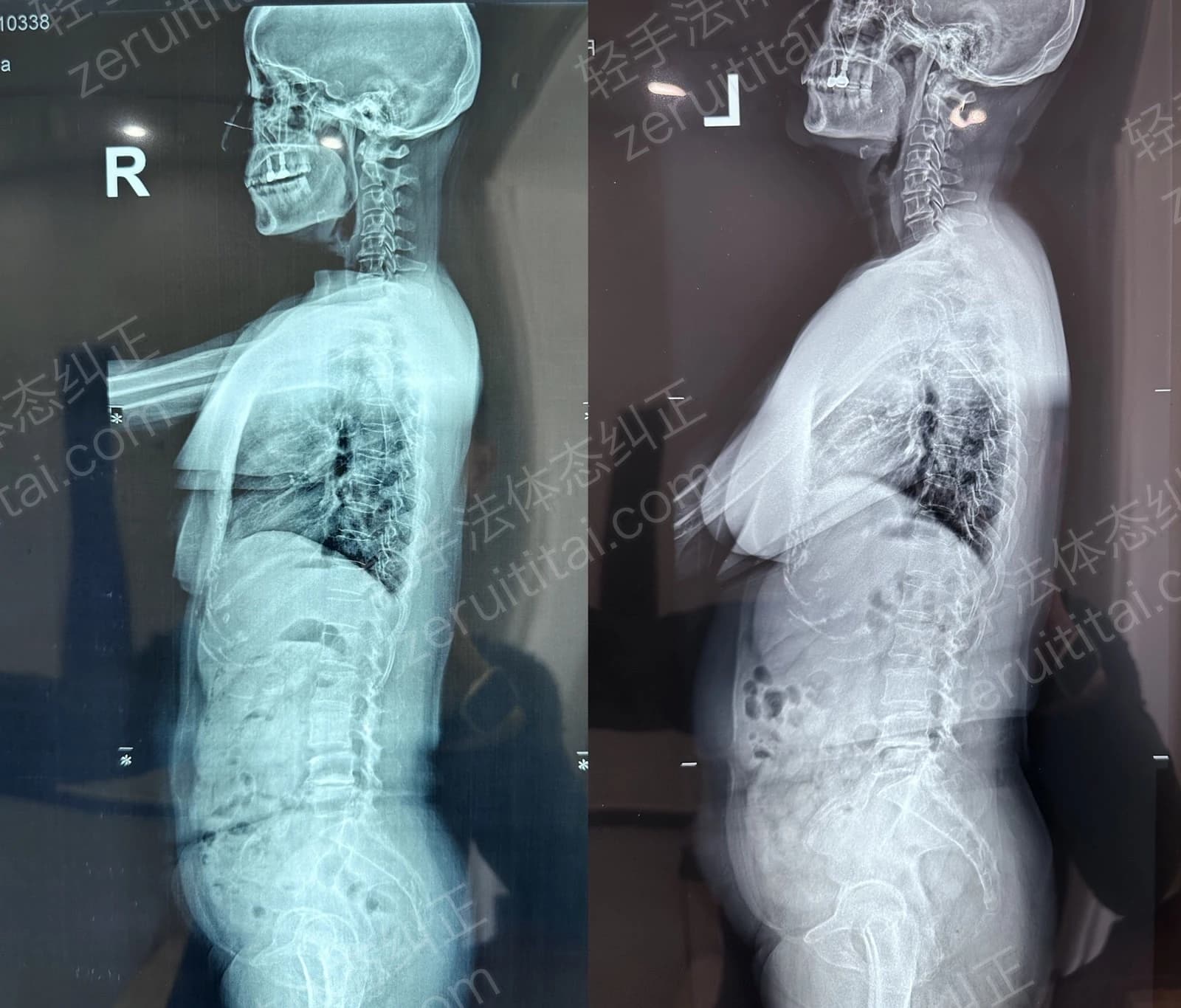 唐云花侧面X光对比图，左侧为2023年7月7日曲度变直，右侧为2024年1月28日正常曲度